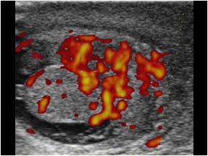 Epididymis with hypervascularization and a reactive hydrocele