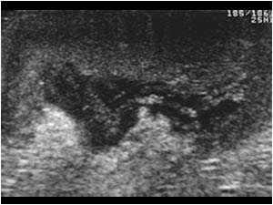 Idiopathic scrotal edema with a thickened scrotal wall
