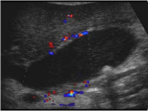 Cholecystitis with a vascularized gallbladder wall