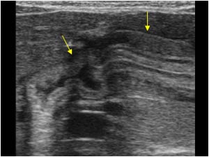 Thickened pyloric muscle impressing the duodenal bulb