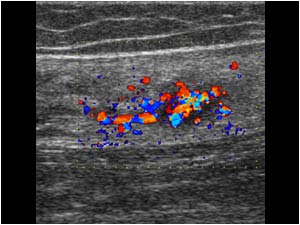 Arteriovenous malformation in the soleus muscle with a highly vascular lesion