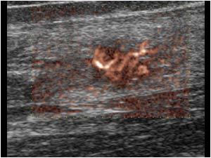 Arteriovenous malformation in the soleus muscle with a highly vascular lesion