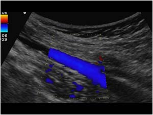 Retrograde flow in the femoral veins during flow augmentation