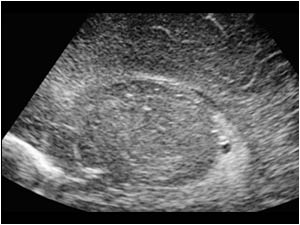 Choroid plexus cyst right side sagittal