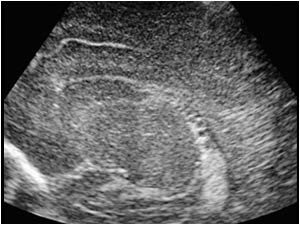 Choroid plexus cyst left side sagittal