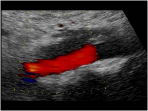 Retroperitoneal fibrosis with a mass around the distal aorta longitudinal
