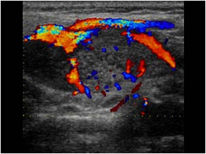 Vascularity in the Warthin's tumor in the left parotid gland