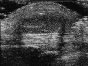 Lipoma anterior of the flexor tendon longitudinal