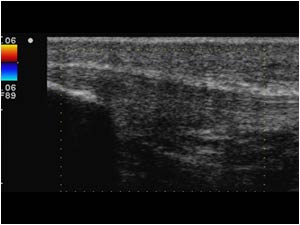 Normal patellar tendon insertion without neovascularity longitudinal