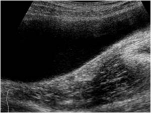Intraperitoneal hemorrhage paracolic gutter