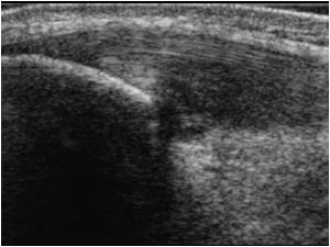 Apexitis longitudinal right knee