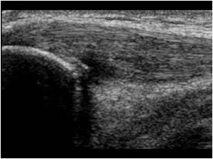 Apexitis longitudinal left knee