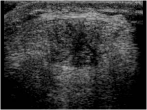 Central area of tendinosis transverse left knee