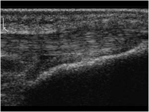 Thickened distal patellar tendon longitudinal