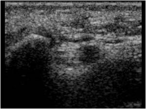 Occluded ulnar artery in Guyon tunnel transverse