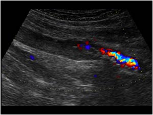 Slow flow in the femoral veins mimicking thrombus longitudinal