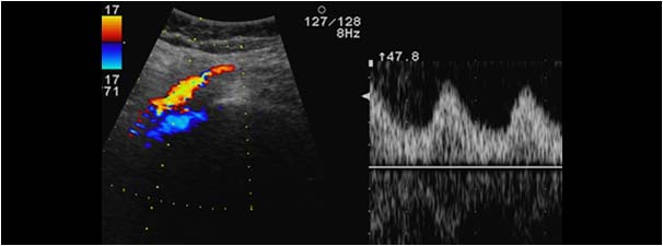 Postobstructive doppler signal with positive diastolic flow in the left iliac artery