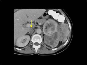 Tumor thrombus in the vena cava