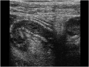 Thickened appendix and enlarged mesenteric lymphe node longitudinal