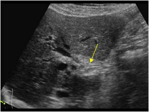 No dilatation of the extrahepatic bile ducts