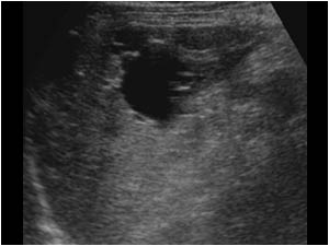 Left liver lobe with cysts cranial of the spleen mimicking splenic cysts