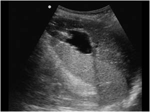 Normal spleen and left liver lobe with cysts