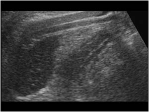 Thickened appendix below the liver longitudinal