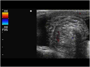 Absence of flow in the epididymis transverse