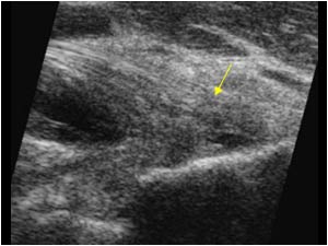 Insertion tendinopathy with small rupture longitudinal
