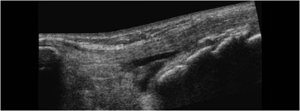 Osgood Schlatter disease extended field of view with effusion in the deep infrapatellar bursa