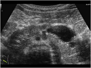 Horseshoe kidney transverse with a dilatated left renal pelvis