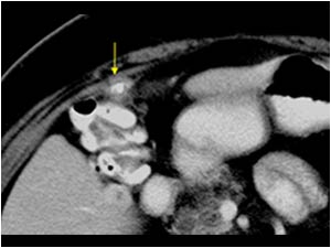 Retained gallstone in the percutaneous cholecystectomy channel CT scan