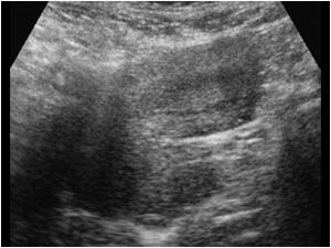 Bicornuate uterus longitudinal right horn