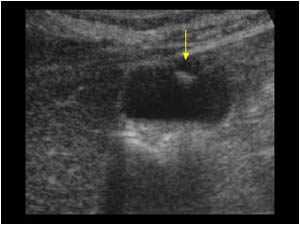 Small phrygian cap deformity or gallbladder diverticulum transverse