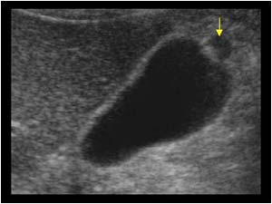 Small phrygian cap deformity or gallbladder diverticulum longitudinal