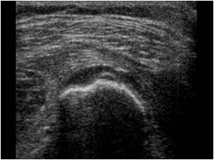 Osteocartilaginous exostosis of the distal femur with a cartilage cap