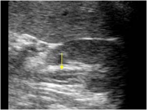 Intermittent pelvic dilatation with a thickened pelvic wall transverse