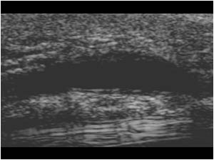 Aneurysm of the ulnar artery longitudinal