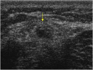 Peroneal nerve and ganglion transverse