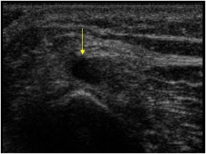 Peroneal nerve and ganglion transverse