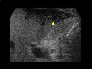 Gallbladder in a patient with hepatitis