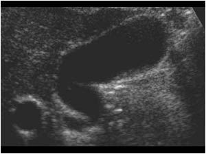 Empty gallbladder and thickened gallbladder wall in a patient with hepatitis