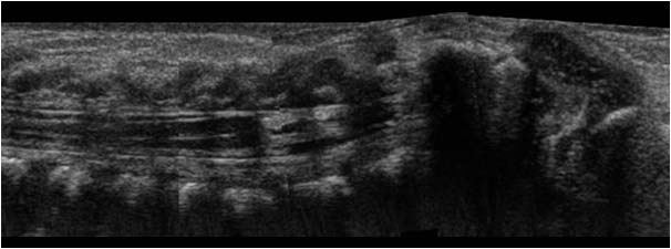 Case of the month February 2006: Neonatal spine