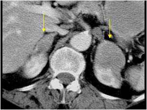 Case of the month June 2006: Adrenal metastases local invasion