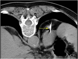 Case of the month June 2006: Adrenal metastases local invasion