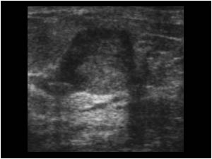 Case of the month May 2006: Atypical benign cysts