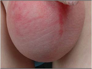 Case of the month July 2006: Idiopathic scrotal edema