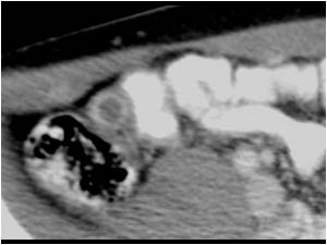 Case of the month August 2006: Abnormalities mimicking an acute appendicitis