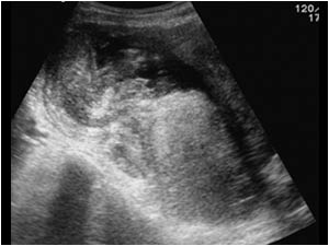 Mucinous adenocarcinoma of the appendix longitudinal