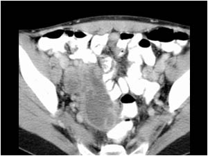 Case of the month November 2006: Various malignant intra abdominal tumors